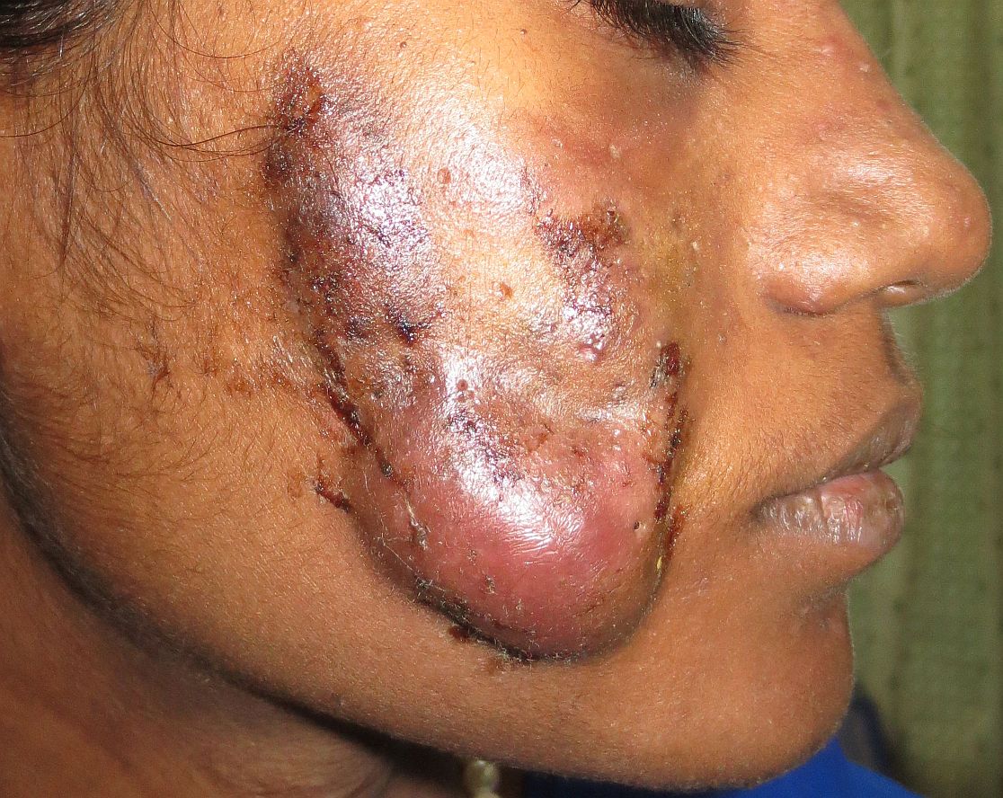 After acne scar treatment