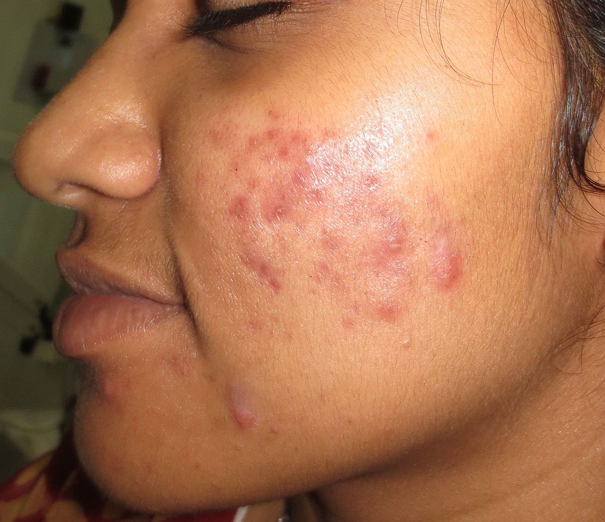 After acne scar treatment