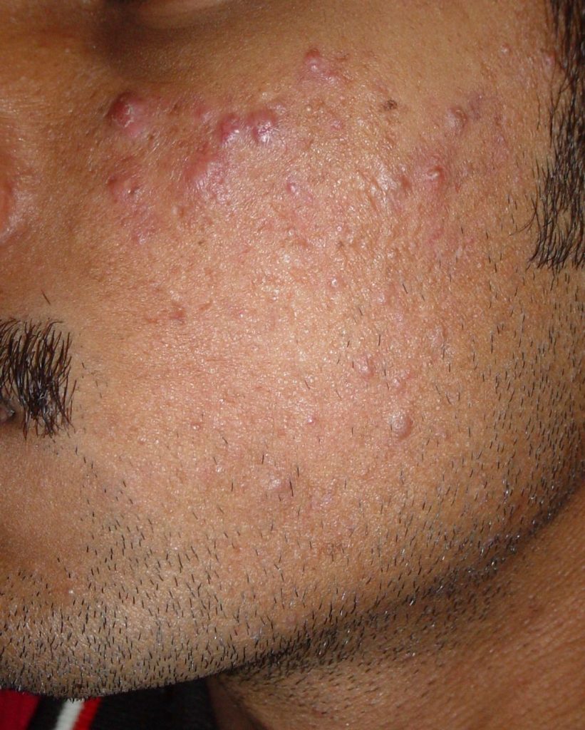 After acne scar treatment