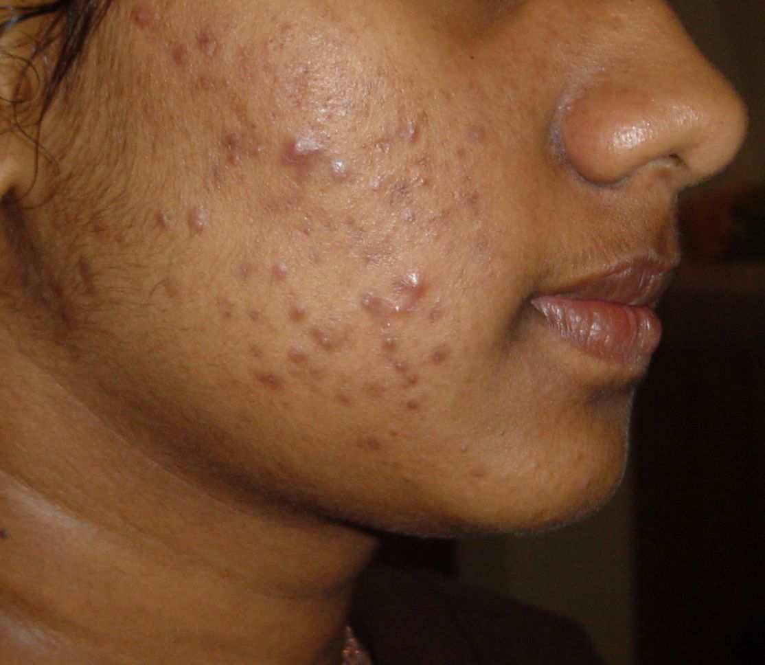 After acne treatment