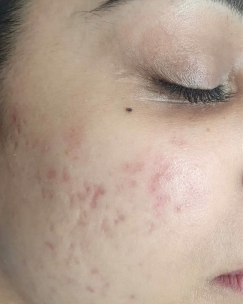 Before acne treatment