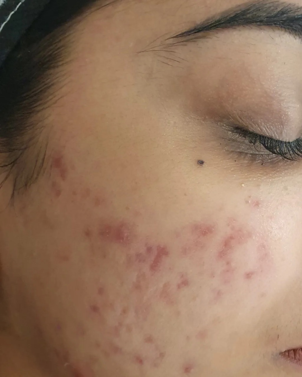 After acne treatment