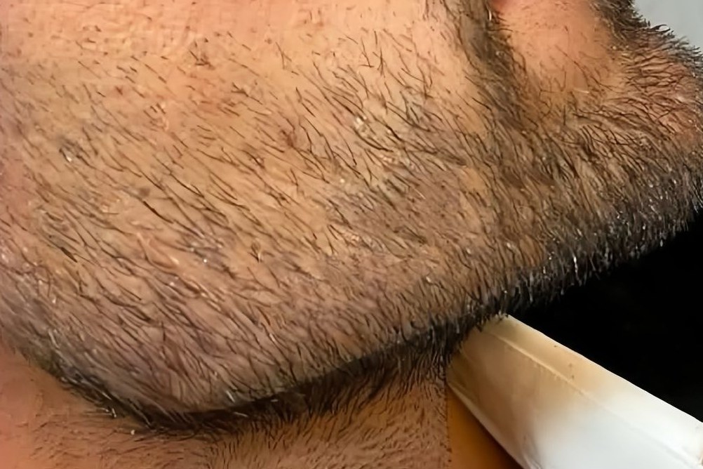 After beard treatment