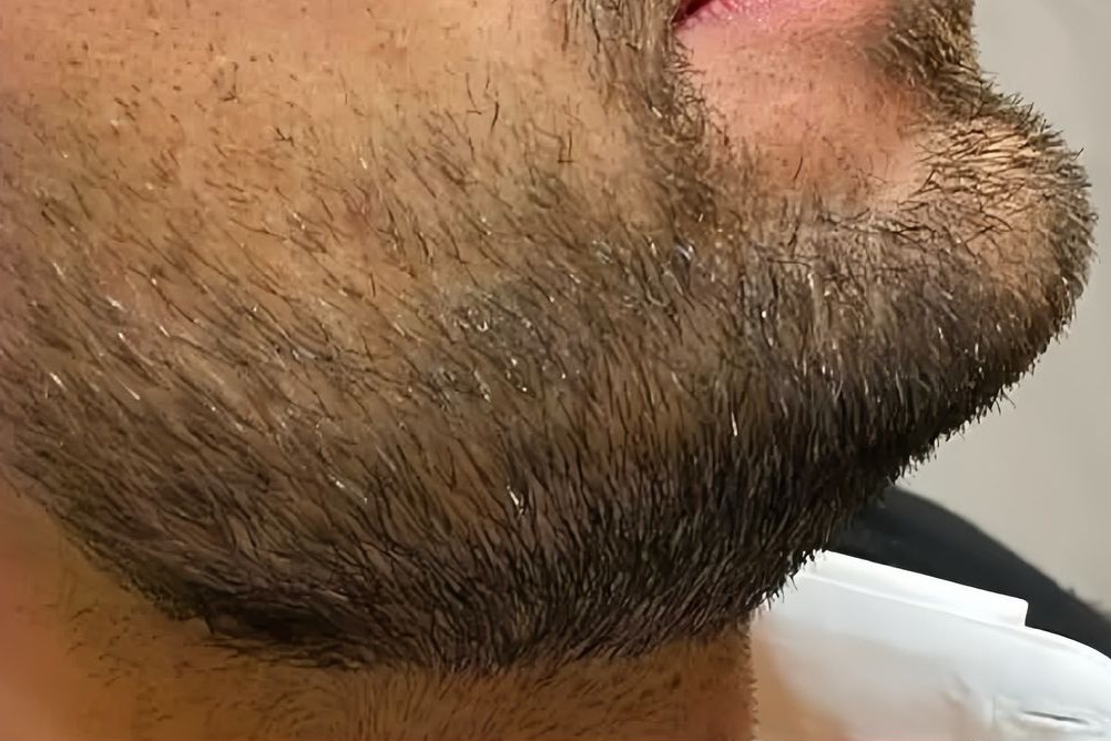 Before beard treatment