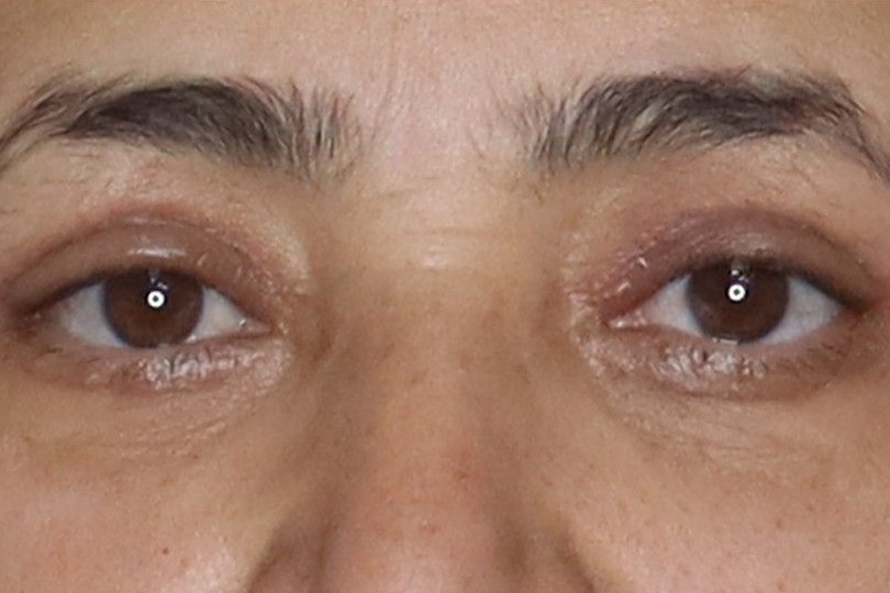 After under-eye filler