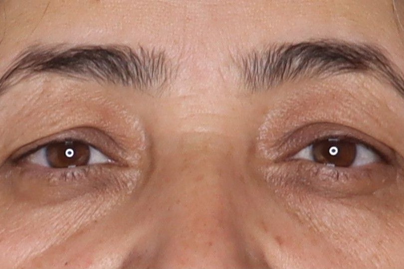 Before under-eye filler