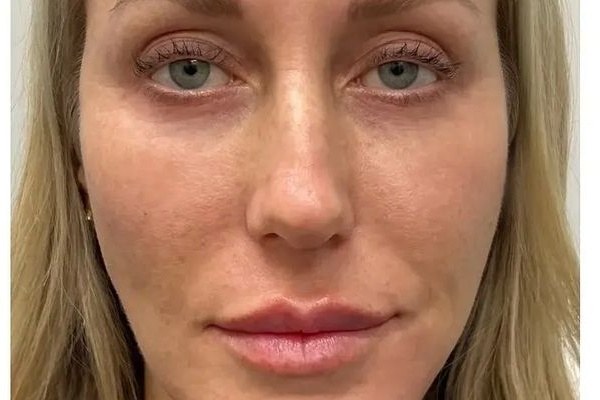 After full-face filler