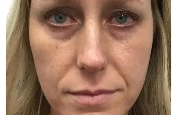 Before full-face filler