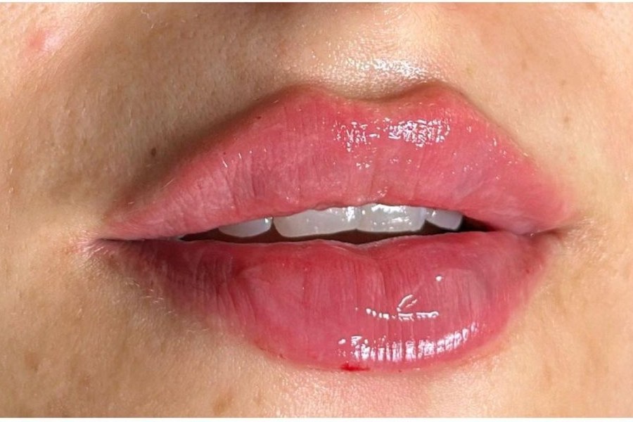 After lip filler