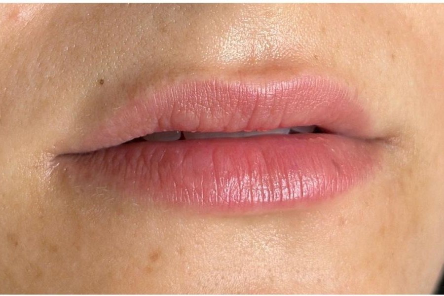 Before lip filler
