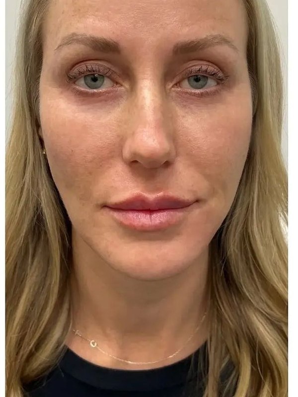 Cheek Filler