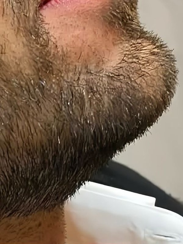 Jawline and Chin Filler