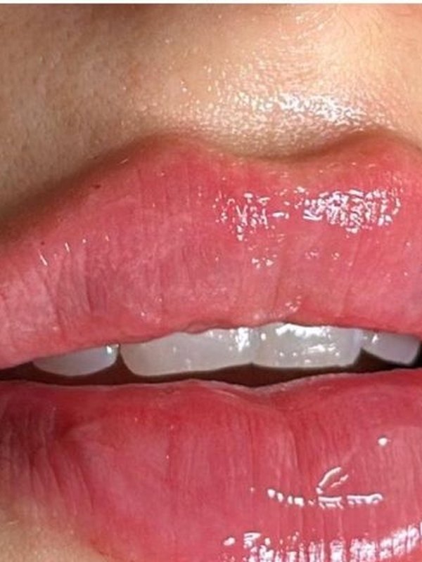 Lip Filler