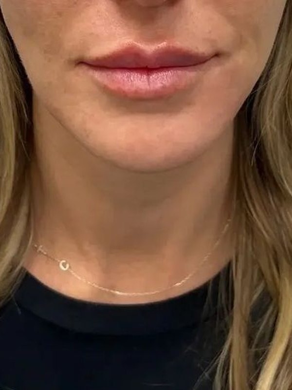 Nasolabial Folds and Marionette Lines Filler