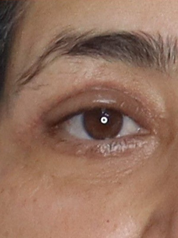 Under Eye Tear Trough Filler