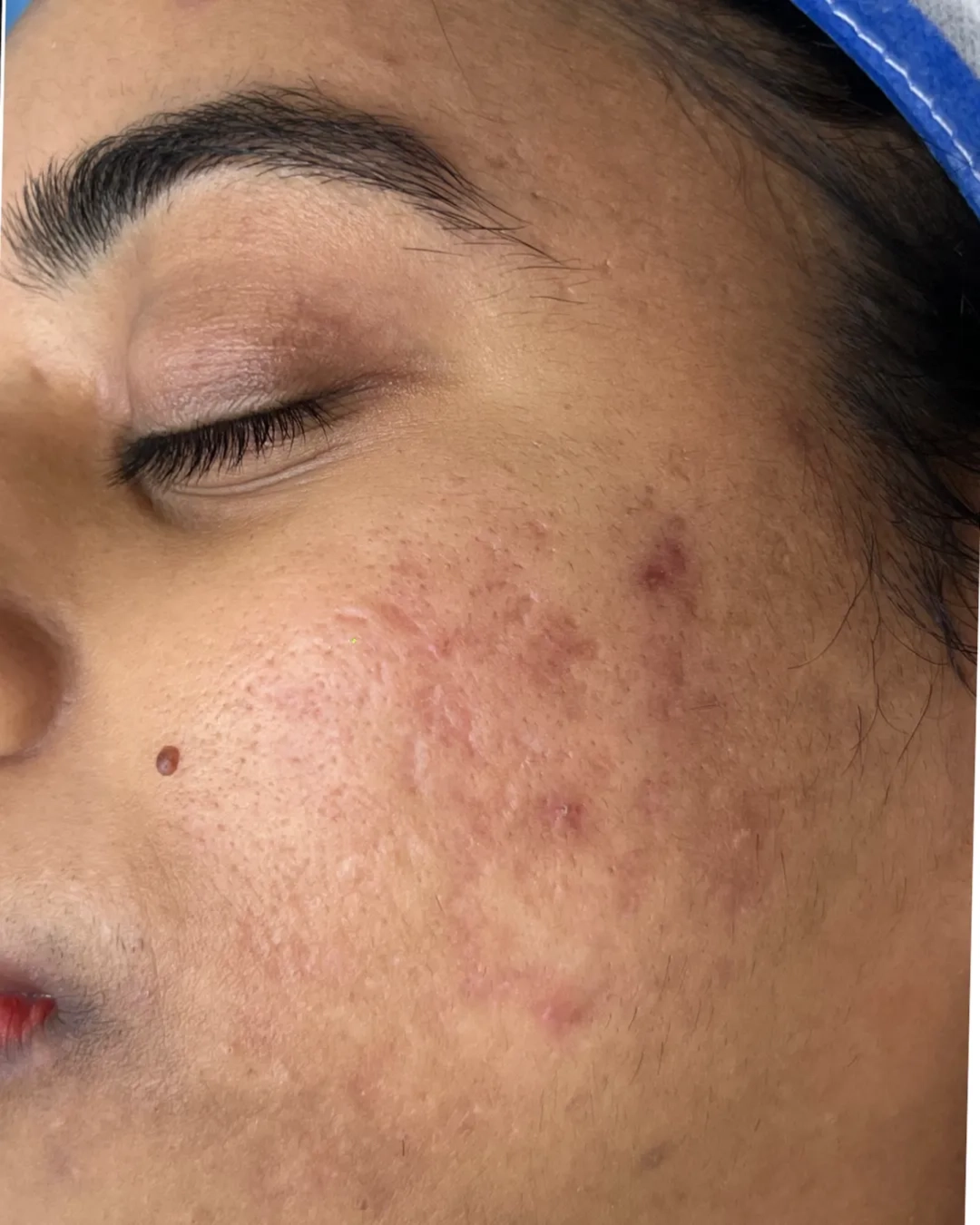 Before acne treatment