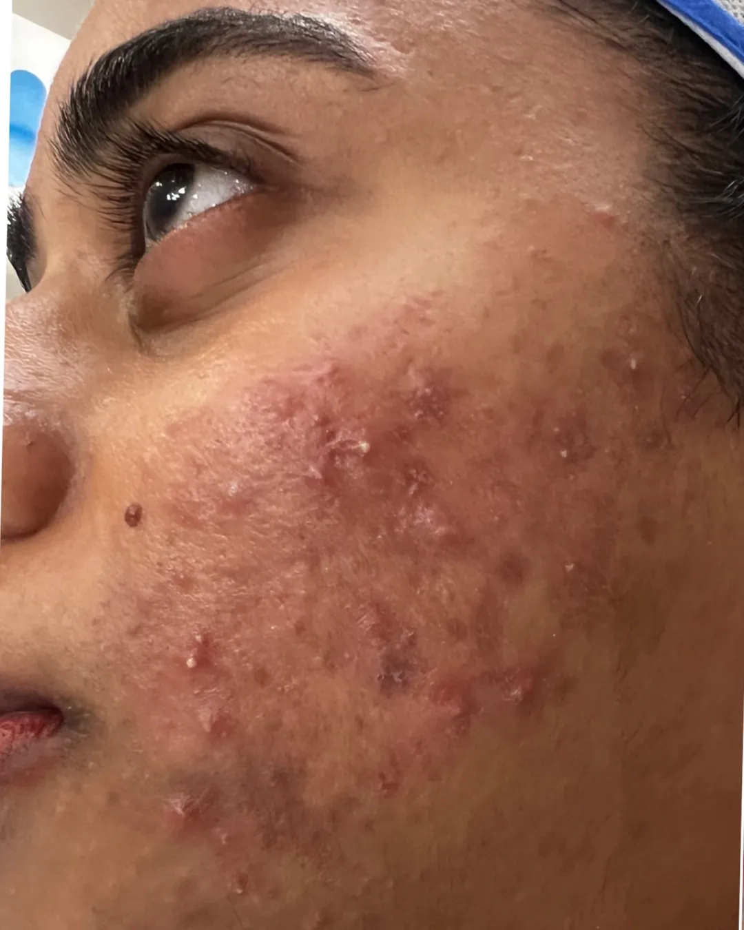 After acne treatment
